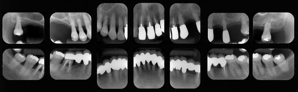 222 Kinumatsu T et al. Fig. 7 Periodontal examination at start of SPT Fig. 8 Radiographic view at start of SPT of 4 mm were found in #18 and 35 (Fig. 7).