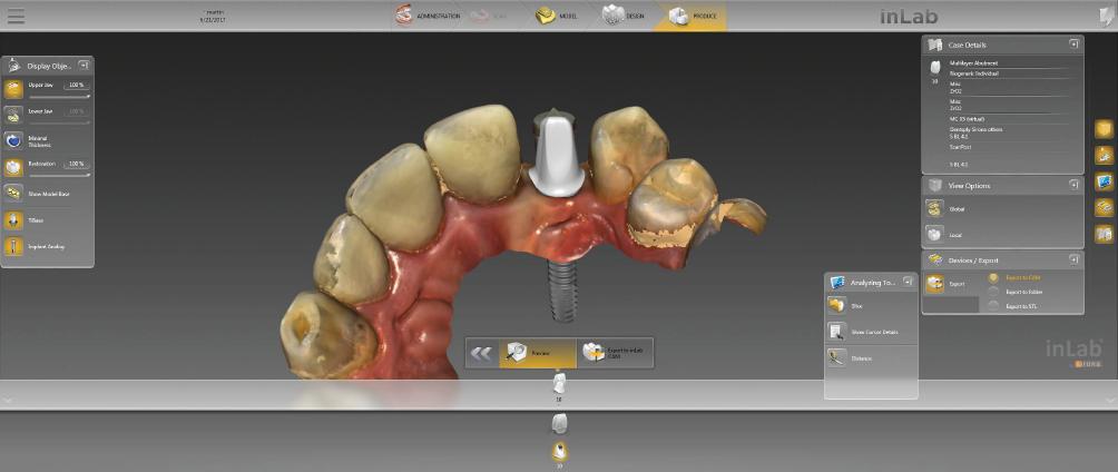 implant, the option of completely ignoring minimum thickness and designing an