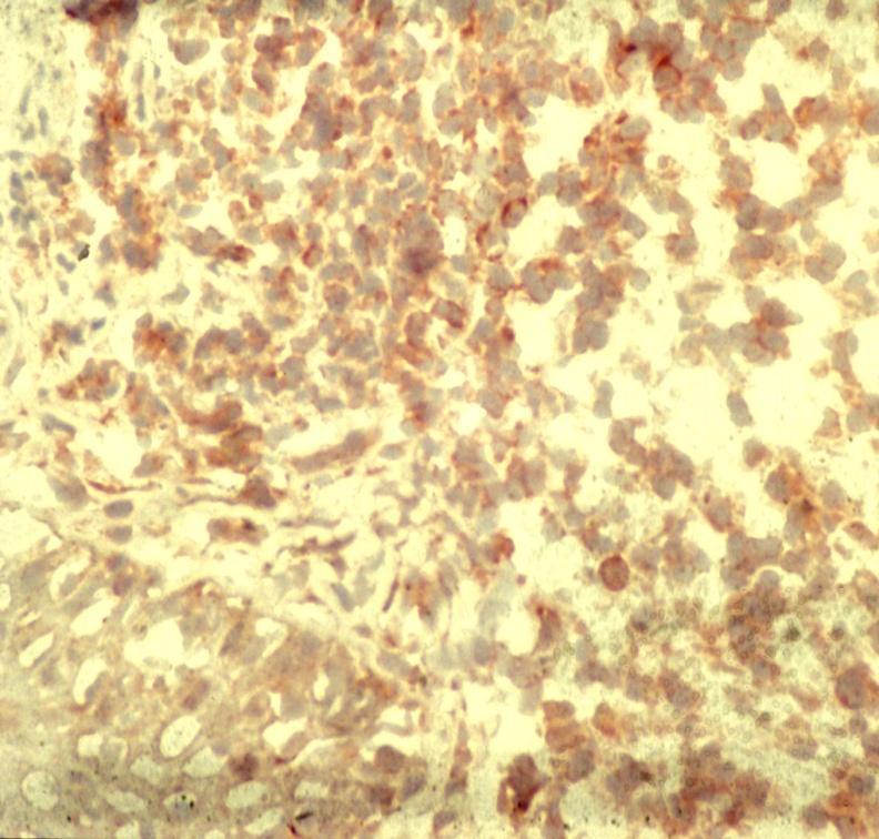 Cytokines in PKDL lesions IL-10 positive cells in the dermal infiltrate.