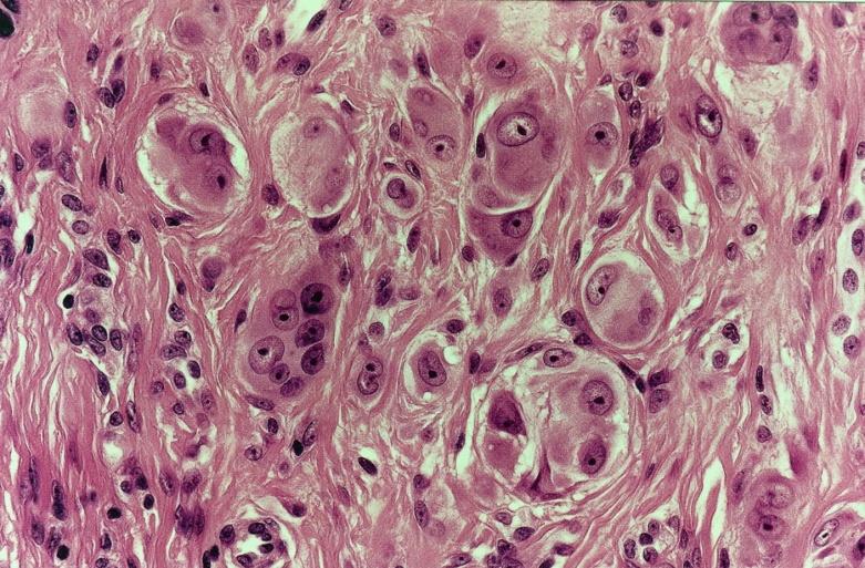 SPITZ NEVUS Melanocytic lesion with characteristic epithelioid morphology, First described by Sophie Spitz in 1948 as juvenile melanoma because of its propensity to