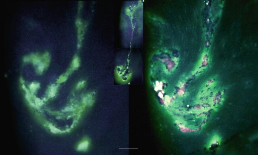 Left: Ter fluid stined green with fluorescein sodium penetrtes into the lesions; confluent surfce deris ppers s strongly light-reflecting plques (rrows).
