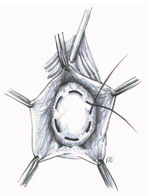 and then simple reinforced sutures between January 2001 and December 2011 was performed. The classification of cystoceles was based on the Baden-Walker halfway system [9].