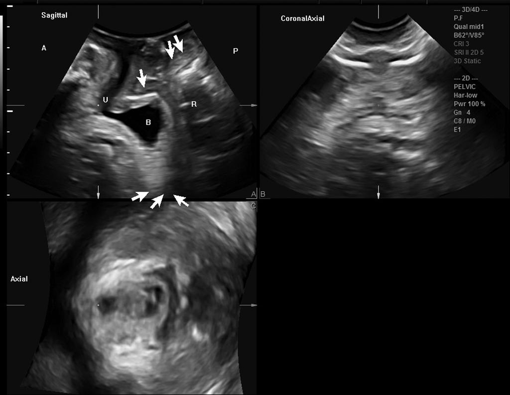 Sacrocolpopexy mesh 401 Figure 1 4D transperineal sonographic multiplanar view showing sacrocolpopexy mesh location (arrows) on maximal Valsalva maneuver in the same patient at two assessments 12