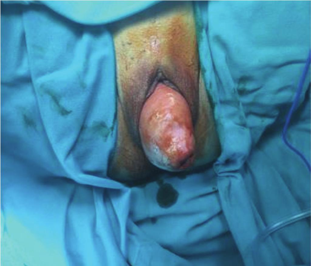 2 CaseReportsinObstetricsandGynecology Figure 1: Preoperative findings of the patient with total pelvic organ prolapse with anterior-posterior and apical prolapse (grade IV).