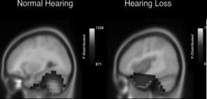 loss (right) show brain reorganization in hearing portions of