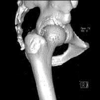Cartilage Delamination 3-D CT scan Pincer