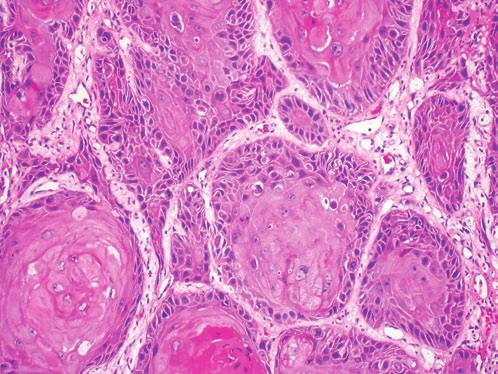 LUNG AND MEDIASTINUM CYTOHISTOLOGY Lung In the current practice, no longer is it sufficient to identify just malignancy.
