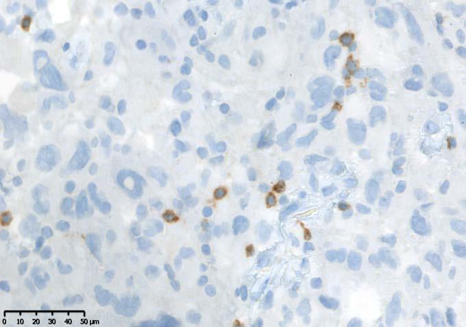 Expression of PD-1 and PD-L1 in glioblastoma tissue PD-1