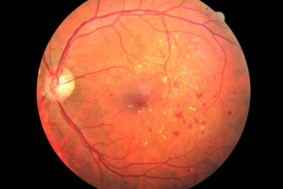 Ophthalmoscopy (dilated fundoscopy,