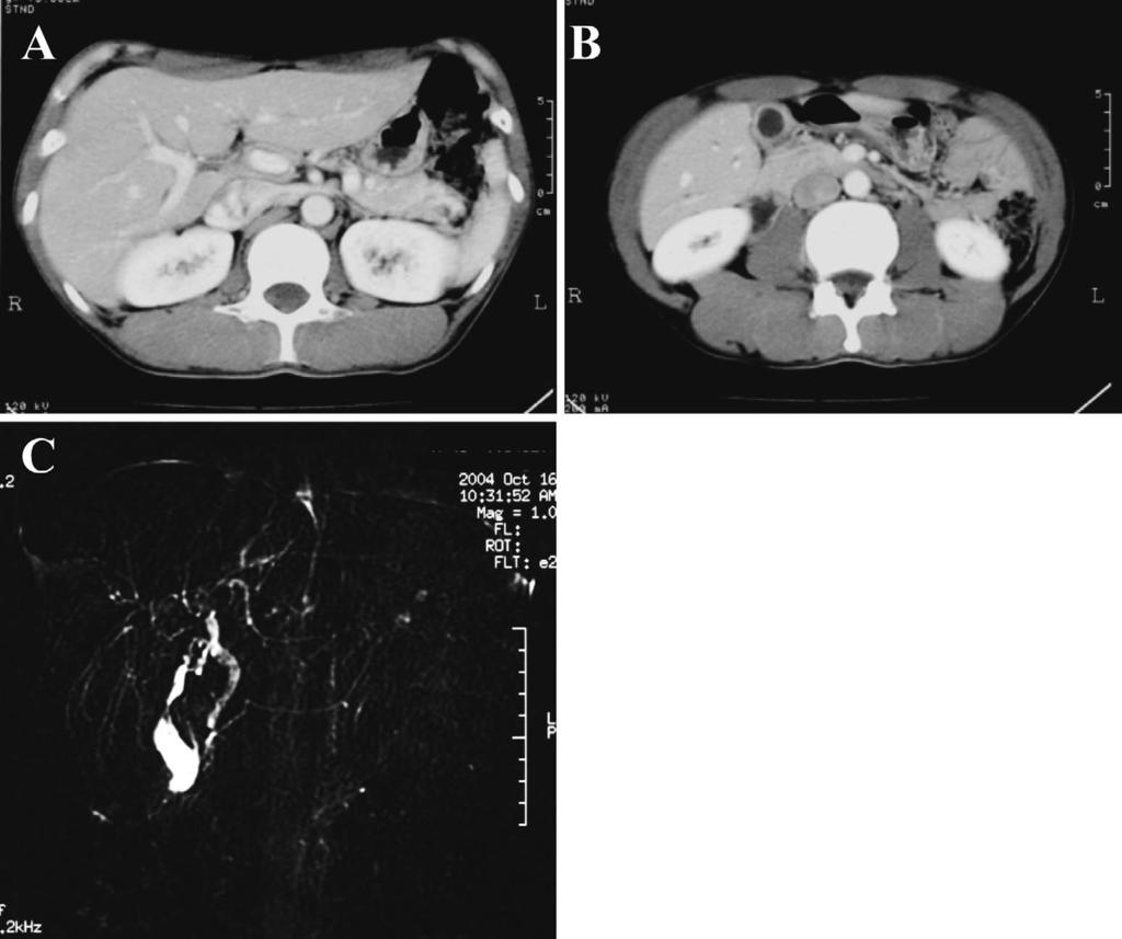 Figure1. Abdominalcomputedtomography(CT)andmagneticresonancecholangiopancreatog raphy(mrcp)findings.