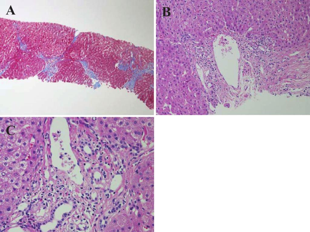 b,c)hematoxylinandeosinstaining. swelling. They diagnosed it to be SSC caused by eosinophilic cholangiopathy based on different criteria from PSC with eosinophilia.