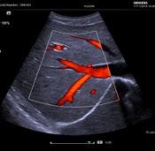 Dynamic Persistence and Auto Flash Artifact Suppression reduce tissue motion and color Doppler artifact, such as the