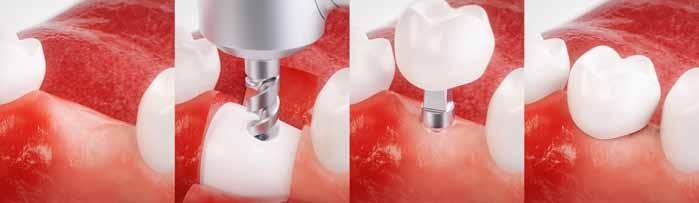 Dental Implant Procedures Preparation of Implant Hole Your dentist will prepare a site in the gum to expose the bone underneath.