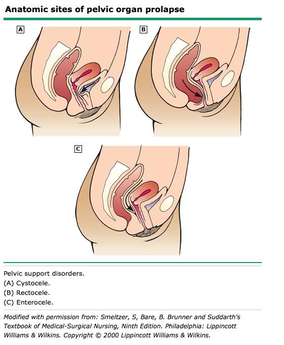 Types of Prolapse Prolapse is classified anatomically Urethrocoele : lower anterior vaginal wall involving urethra Cystocoele : upper anterior vaginal wall involving bladder and often urethra Apical