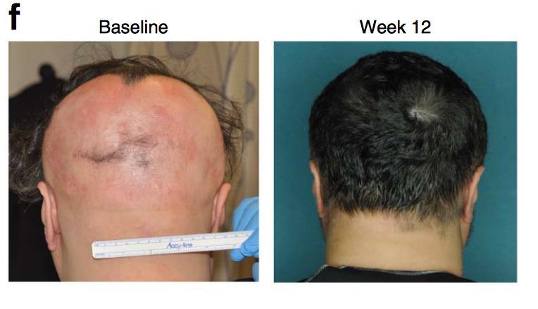 Alopecia areata reversed by JAK inhibition Alopecia areata (AA) mediated by T-cell autoimmune process In a mouse model giving anti- IFN-g antibodies prevented AA