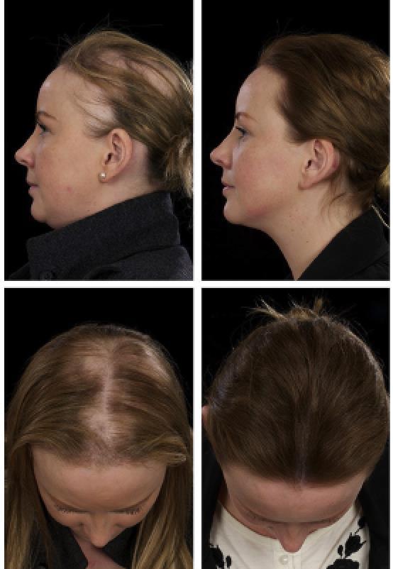 Ruxolitinib successfully treats chronic mucocutaneous candidasis in GOF STAT1 28 yr old female with GOF STAT1 Alopecia,
