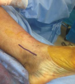 Soft Tissues Straight incisions Avoid Curving, J or any other