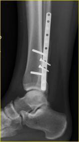 fracture patterns Lag Screws and Neutralization Plates Posterior Anti-glide Operative Lateral Malleolus