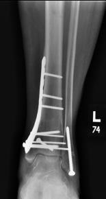 Lateral Malleolus