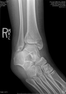 Syndesmotic Injury All rotational ankle fractures have some degree of syndesmotic injury(ser, PER) Reduction and stabilization of a