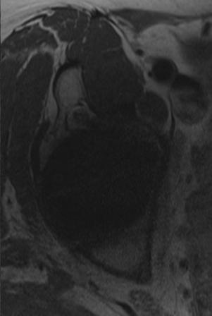 MARS MRI: Utility Osteolysis MRI accurate in detecting wear induced adverse synovial response predating osteolysis on radiographs