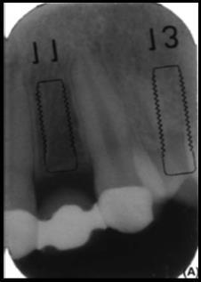 7 Shape of the Missing and Adjacent Teeth The shape of the missing and adjacent teeth can profoundly influence the degree of risk associated with implant-supported restorations in the esthetic zone.