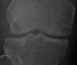 Findings Joint effusion Synovial hypertrophy &