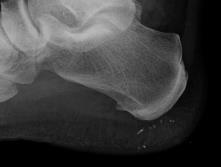 Radiographs Detection of Infection: Radiographs Bone destruction, periosteal reaction, osteosclerosis, sequestra, involucrum