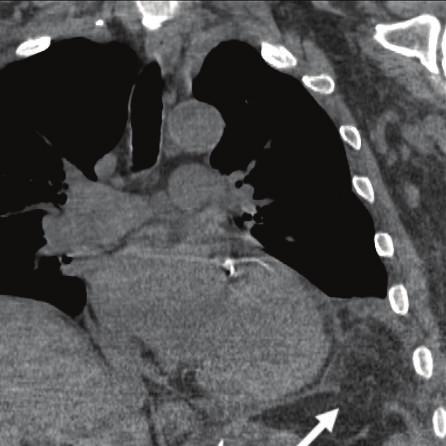 and 2(b)). In addition, left lung contusion and tiny left pneumothorax were present. ArepeatMDCTwasperformedfourdayslatertoevaluate an enlarging left pleural effusion.