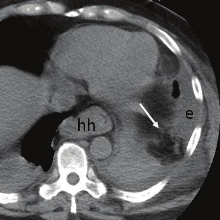 Left-sided diaphragmatic injuries are typically more clinically apparent and symptomatic [8].