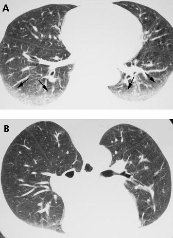 HRCT scanning of the lung for idiopathic interstitial pneumonias 547 Figure 1 Value of prone high resolution (HR) CT imaging: resolution of dependent lung opacity.