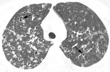 548 Gotway, Freemer, King Figure 3 Patient with suspected idiopathic interstitial pneumonia: alternative diagnosis established with high resolution (HR) CT imaging.