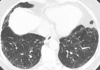 1 If HRCT findings typical of UIP are found, one may confidently suggest the diagnosis of UIP and surgical lung biopsy may be avoided.