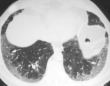 HRCT scanning of the lung for idiopathic interstitial pneumonias 549 Figure 6 Pattern of non-specific interstitial pneumonia (NSIP) on high resolution (HR) CT imaging shows bilateral subpleural