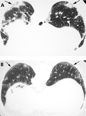 550 Gotway, Freemer, King Figure 9 Non-specific interstitial pneumonia (NSIP) on high resolution (HR) CT imaging: improvement with treatment.