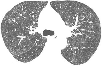 SMOKING-RELATED INTERSTITIAL LUNG DISEASES: RESPIRATORY BRONCHIOLITIS-INTERSTITIAL LUNG DISEASE (RB-ILD) AND DESQUAMATIVE INTERSTITIAL PNEUMONIA (DIP) While a history of smoking is almost always