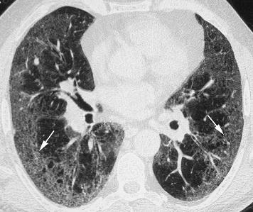 HRCT scanning of the lung for idiopathic interstitial pneumonias 551 Figure 13 Desquamative interstitial pneumonia (DIP) on high resolution (HR) CT imaging.