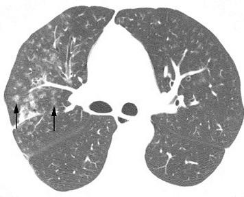 552 Gotway, Freemer, King Figure 17 Lymphocytic interstitial pneumonia (LIP) on high resolution (HR) CT imaging: centrilobular ground glass attenuation nodules.
