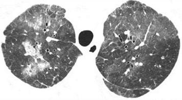 27 When lymphatic tissue along more central bronchovascular structures is primarily affected, HRCT scans will show more solid-appearing nodules studding vessels and bronchi (fig 19).