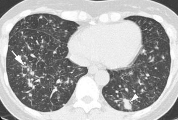 27 Because interlobular septal infiltration is commonly found histopathologically in patients with LIP, interlobular septal thickening is often encountered on HRCT scans in patients with LIP.