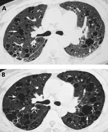 HRCT scanning of the lung for idiopathic interstitial pneumonias 553 Figure 21 Lymphocytic interstitial pneumonia (LIP) on high resolution (HR) CT imaging: cysts.