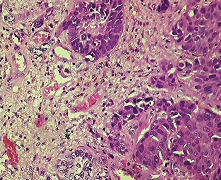 Peripheral nerve sheath tumors, WHO: World Health Organization Figure 4: Metastatic carcinomatous deposits (H&E X100) Figure 5: Anaplastic Astrocytoma exhibiting vascular proliferation.