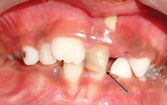 Kotumachagi Sangappa Suresh et al Interceptive procedures should be undertaken as soon as sufficient permanent teeth have erupted,