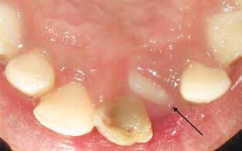 5 The objective of this paper is to report a case series of ectopically erupting maxillary incisors and their management in the