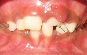 2A) were reported to our department with the chief complaint of abnormally erupting tooth in the upper front region.