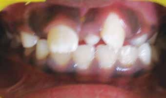 Management of Ectopically Erupting Maxillary Incisors: A Case Series Intraoral examination revealed early mixed dentition with erupted mesiodens between the upper