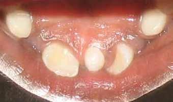 According to the treatment plan, erupted mesiodens was extracted for fixed orthodontic intervention (Fig. 3B).