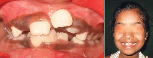 Management of Ectopically Erupting Maxillary Incisors: A Case Series Fig.