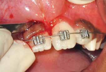 016" nickel titanium archwire was placed and left lateral incisor was bracketed after it had erupted sufficiently for