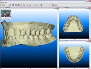 icast Digital Models OrthoCAD software and ortho analysis tools